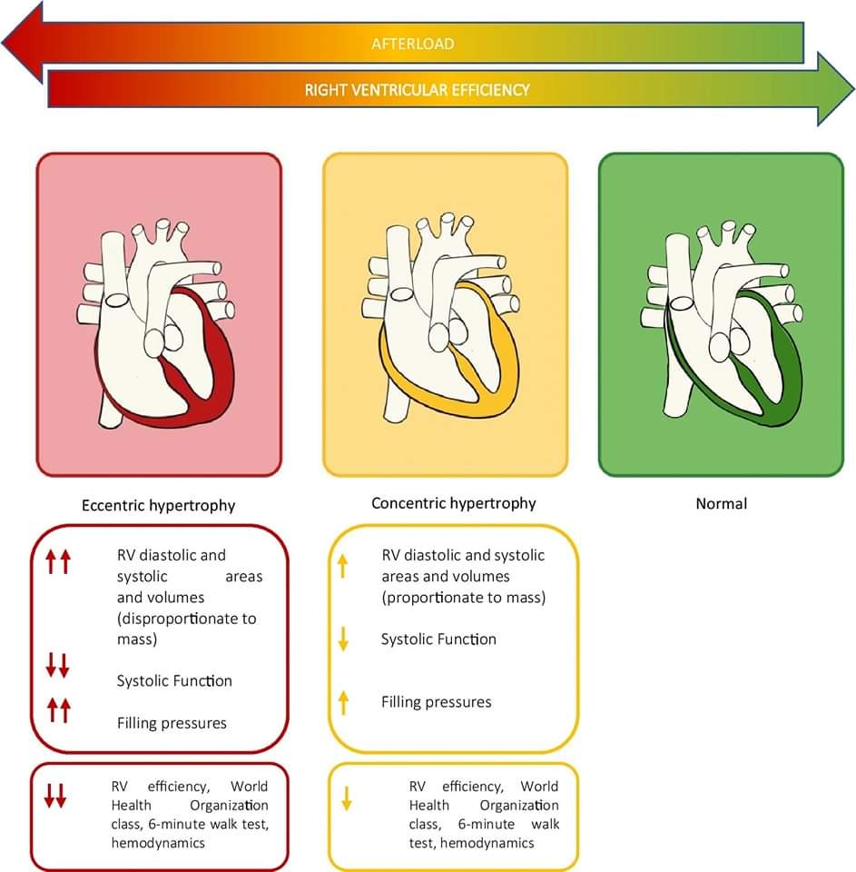 🔴 Medical Management of Right Ventricular Dysfunction in Pulmonary Arterial Hypertension #openaccess #2023Review 
 
link.springer.com/article/10.100…
#CardioEd #Cardiology #FOAMed #meded #MedEd #Cardiology #CardioTwitter #cardiotwitter #cardiotwiteros #CardioEd #MedTwitter #MedX