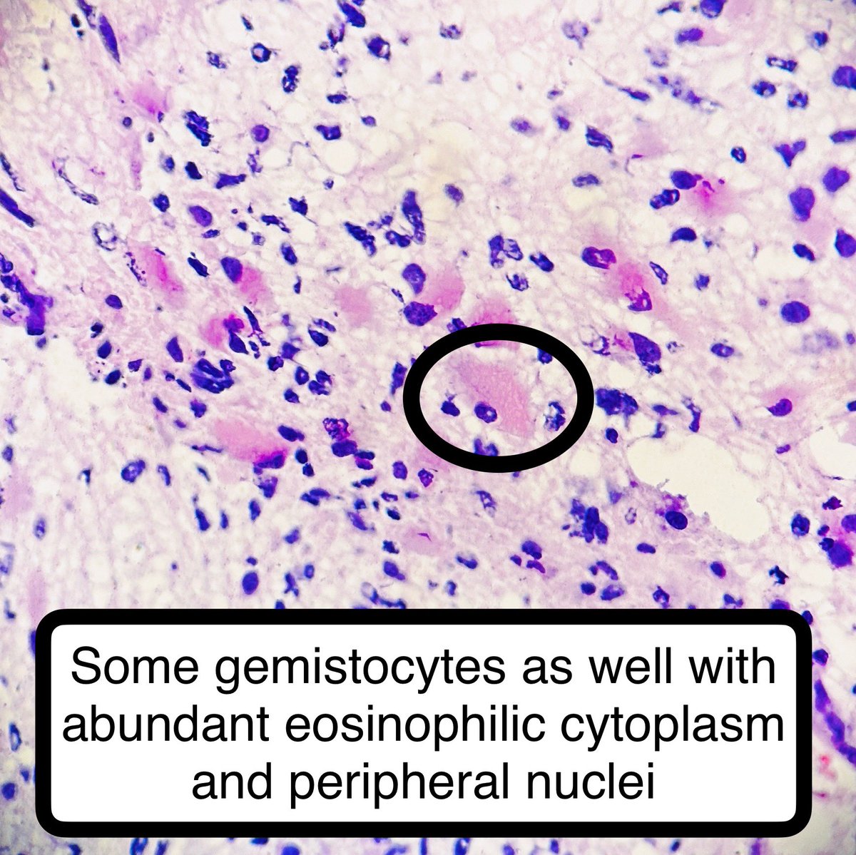 This was a Squash smear and frozen from a craniotomy. 

I had the fortune of doing it with a neuropathologist 🙏🏼

Final Intraoperative Dx: High Grade Glial Neoplasm. 

#pathagonia #path4people #neuropath #neurosurg #pathx #pathtwitter #frozens #pathology #medstudenttwitter