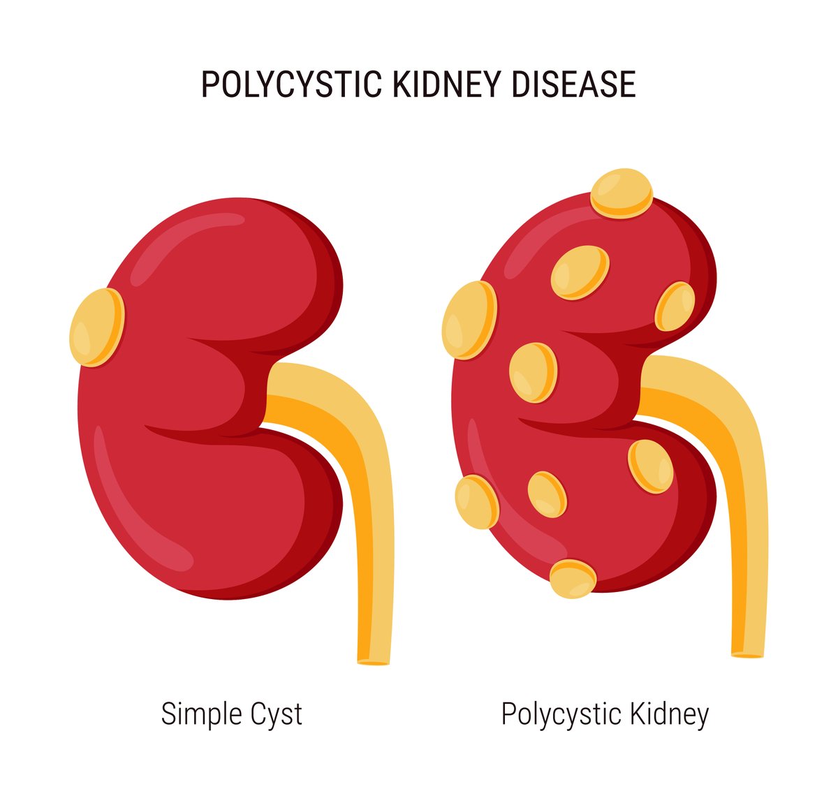 There are two kinds of peritoneal dialysis: @nkf * Continuous Ambulatory Peritoneal Dialysis (CAPD) * Automated Peritoneal Dialysis (APD) Read here - ow.ly/5Vqu50R86gQ #health #dialysis #transplant #KidneyDisease #CKD #ClinicalRenalAssociates