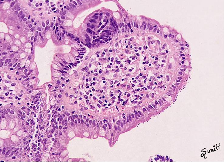 After a long hiatus 
68 year old female, presenting with watery diarrhea. What is the diagnosis?
#pathTwitter #pathology #frcpath #pathresidents #GIpath