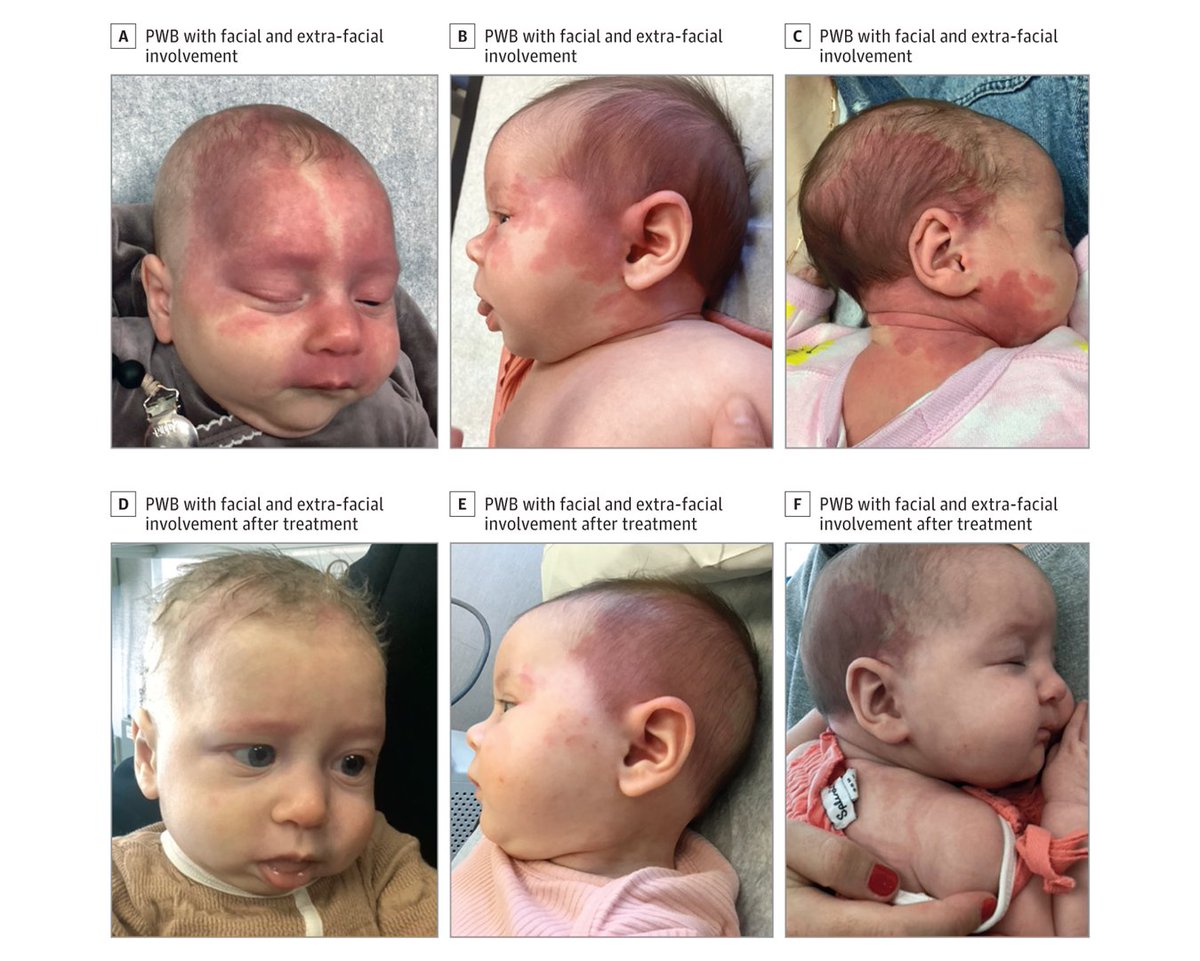 During the first few months of life, once-weekly pulsed dye laser treatments for port-wine birthmark are associated with improved therapeutic outcomes and shorter overall treatment duration. ja.ma/4d0c3qG