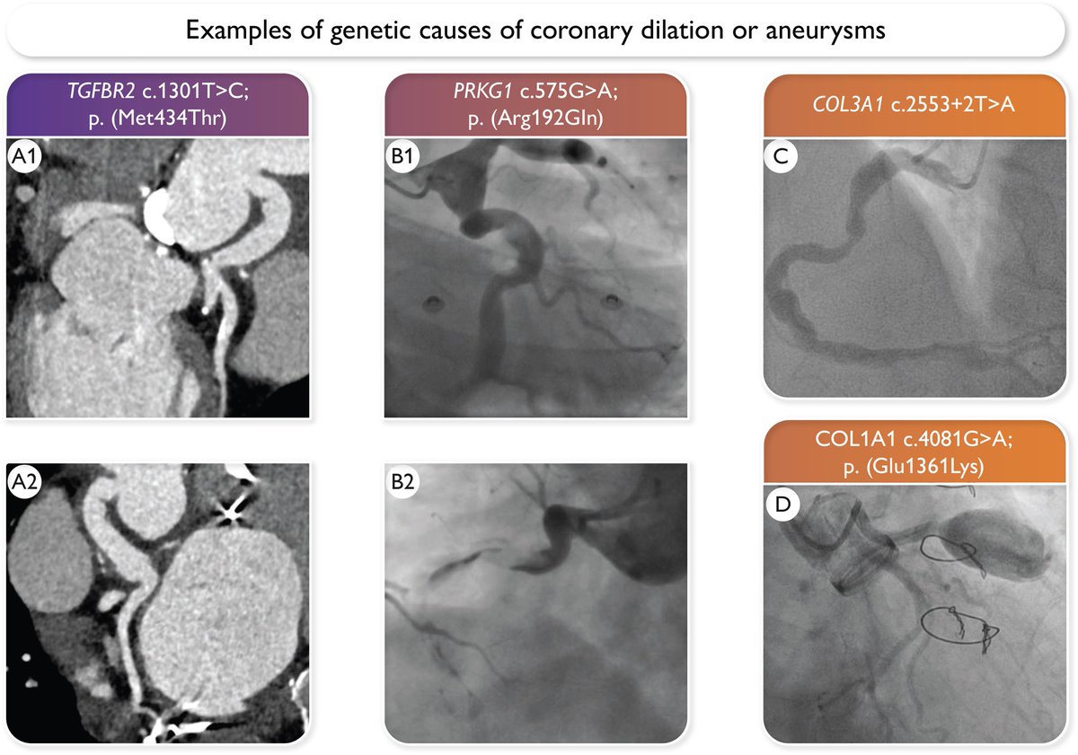 Genetic testing in patients with unexplained coronary aneurysms or dilation. Read more in #EHJ: academic.oup.com/eurheartj/adva… #genetics #coronary #aneurysm @escardio @ESC_Journals