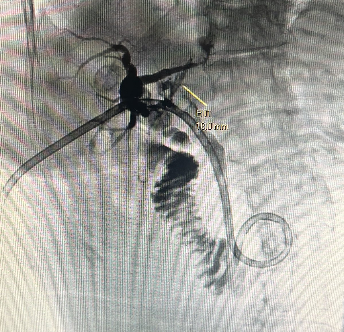 spautasso79's tweet photo. Today we ve performed a Percutaneous transhepatic holmium laser lithotripsy for cholecystolithiasis !  💪🏻 gracias por la confianza Dr Sergio Lucino. Instituto Oulton. https://t.co/3HsgKCcIYv