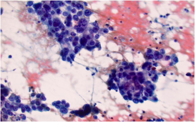 In iNNOVATIONS: iMAGES in iGIE, Phung et al participate in 'Diagnosis of lung squamous cell carcinoma using EUS-guided fine-needle biopsy sampling of a lung lesion.' igiejournal.org/article/S2949-… @BilalMohammadMD @MetabolicEndo @gutdoc18