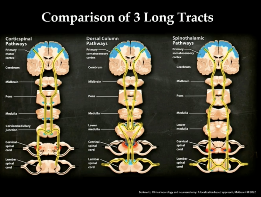 Johanna Seiden, MD MPH (@johannaseidenmd) on Twitter photo Clear and concise schematic of the 3 long tracts, the "spine" of neuroanatomy. Thank you <a href="/AaronLBerkowitz/">Aaron Berkowitz</a> for a wonderful review at #AANAM #MedTwitter #MedEd #EndNeurophobia #Neurotwitter Clear and concise schematic of the 3 long tracts, the "spine" of neuroanatomy. Thank you <a href="/AaronLBerkowitz/">Aaron Berkowitz</a> for a wonderful review at #AANAM #MedTwitter #MedEd #EndNeurophobia #Neurotwitter
