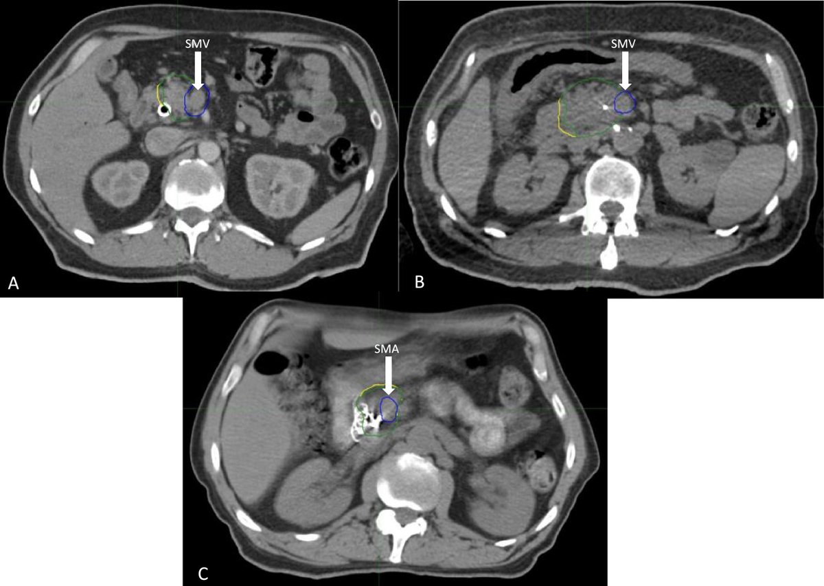 In the #RedJournal RT QA analysis of A021501, the first trial of neoadjuvant SBRT for BR #pancsm highlights important lessons for future clinical trials in this space. @LeilaTchelebi @JoeHermanMD. #radonc bit.ly/tchelebi2