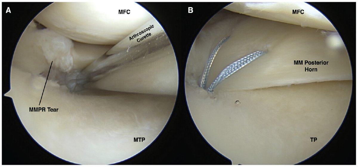 Systematic review of 11 studies reports the incidence of complications after isolated posterior medial meniscal root repair at 9.7% and of repair failure at 3%. What are the most common complications? ow.ly/jHKa50RjgYh @grjacksoo @Chicagosportsdoc @jachahla @MOR_Docs