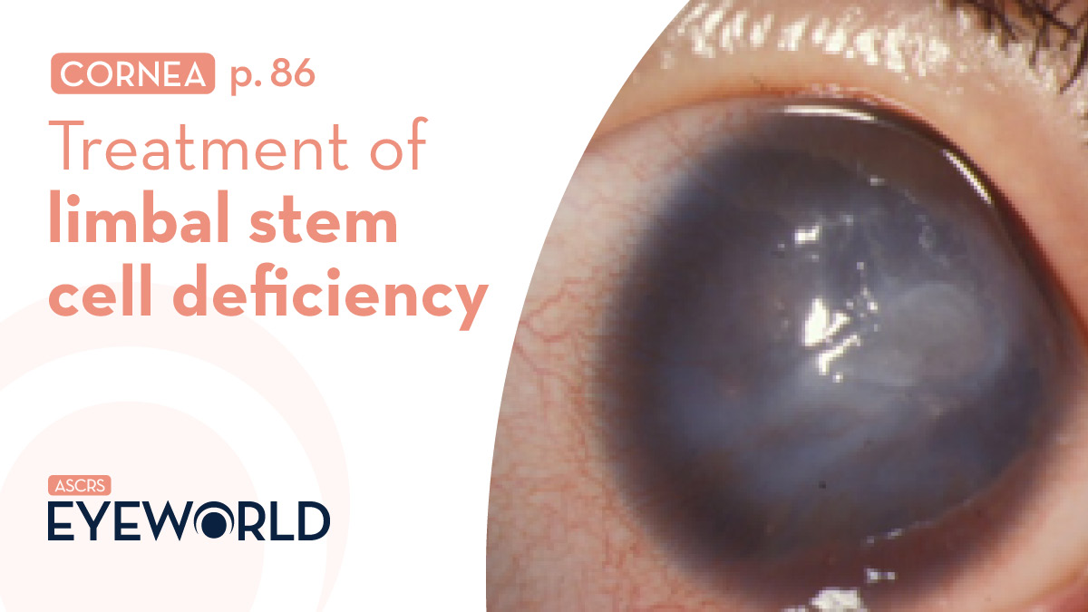 Identifying and treating patients with limbal stem cell dysfunction or deficiency can be a challenging process. Several physicians discussed how they handle these patients in #EyeWorldMagazine bit.ly/49ZR5pZ