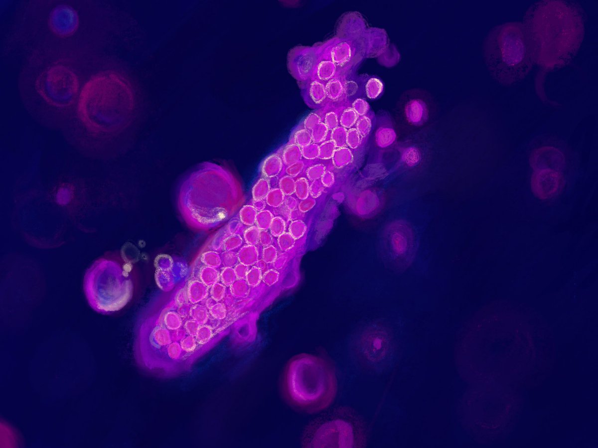 Serenella Velez (@serenellaavelez) on Twitter photo Digital painting of a red blood cell cast I did! I’ve been experimenting with a creative approach to microscopy images, these pictures truly are art. Reference photo credits <a href="/VelezNephHepato/">Juan Carlos Q Velez</a> #Urine #UrineMicroscopy #Microscopy #Procreate #Medicalllustration #RBCC Digital painting of a red blood cell cast I did! I’ve been experimenting with a creative approach to microscopy images, these pictures truly are art. Reference photo credits <a href="/VelezNephHepato/">Juan Carlos Q Velez</a> #Urine #UrineMicroscopy #Microscopy #Procreate #Medicalllustration #RBCC
