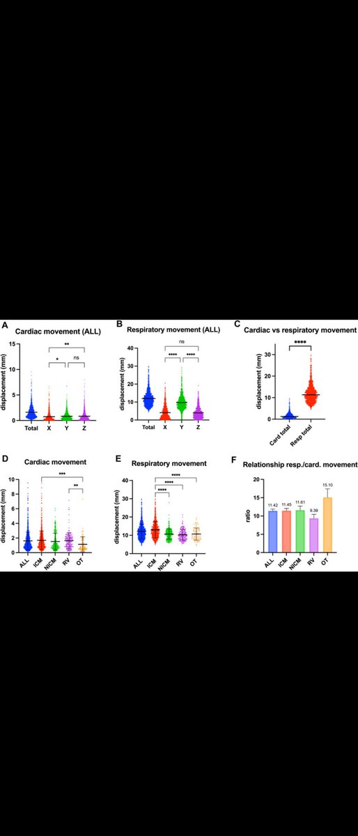 Karim Benali (@karimbenali42) on Twitter photo New insights regarding magnitude of cardio-respiratory motions of different target regions during cardiac SBRT 🫀⚡☢️📊
In <a href="/HRS_O2Journal/">Heart Rhythm O2</a>
tinyurl.com/2ptnxzm3
Congrats <a href="/adrian_petzl/">Adrian Petzl</a> <a href="/purerfellner/">Dr. Helmut Pürerfellner</a> <a href="/CHURennes/">CHU de Rennes</a> <a href="/ChuSaintEtienne/">CHU de Saint-Étienne</a> <a href="/ICMtl/">ICMtl</a> New insights regarding magnitude of cardio-respiratory motions of different target regions during cardiac SBRT 🫀⚡☢️📊
In <a href="/HRS_O2Journal/">Heart Rhythm O2</a>
tinyurl.com/2ptnxzm3
Congrats <a href="/adrian_petzl/">Adrian Petzl</a> <a href="/purerfellner/">Dr. Helmut Pürerfellner</a> <a href="/CHURennes/">CHU de Rennes</a> <a href="/ChuSaintEtienne/">CHU de Saint-Étienne</a> <a href="/ICMtl/">ICMtl</a>