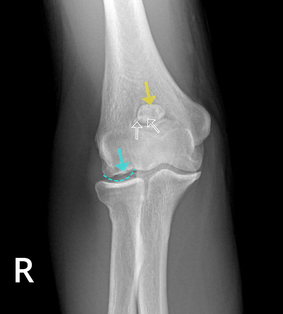 The blue arrow-the abnormal articular surface of the capitellum, and the blue dotted line -expected shape of the capitellum - Osteochondritis dissecans of the elbow and synovial osteochondromatosis radiopaedia.org