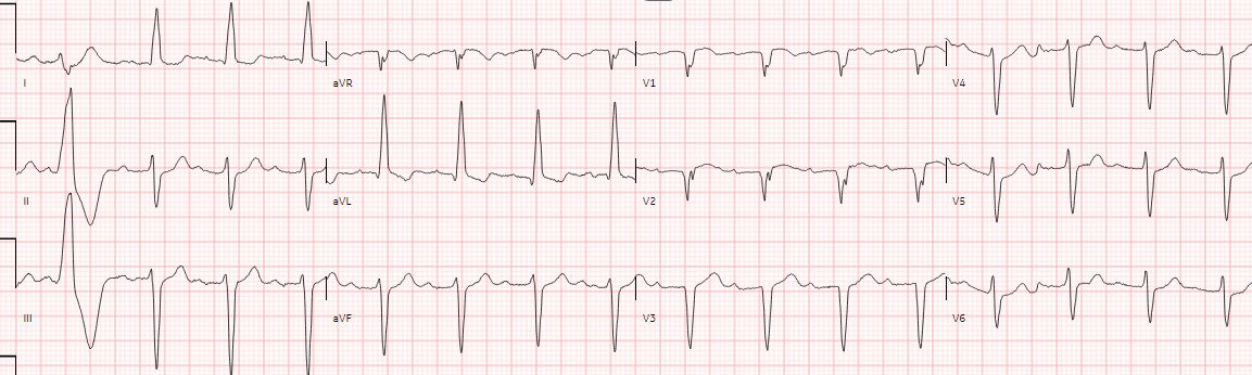 Is OMI an ECG Diagnosis?  (STEMI certainly is!!)

hqmeded-ecg.blogspot.com/2024/04/is-omi…

@ECGcases