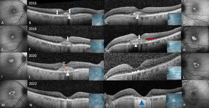 Eyes with adult-onset foveomacular vitelliform dystrophy possess clinical & imaging features which confer increased risk for progression to choroidal neovascularization or atrophy. ow.ly/zsay50QYUfQ