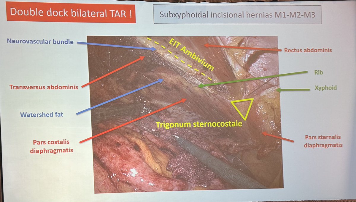Super session on complex hernia repair from the hernia masters at #SAGES2024. Full of pearls like this slide from ⁦@FilipMuysoms⁩ on them subtle details of subxiphoid anatomy
⁦@SAGES_Updates⁩ 
⁦@NovitskyYuri⁩ ⁦@herniabarbie⁩ ⁦@Neil_J_Smart⁩