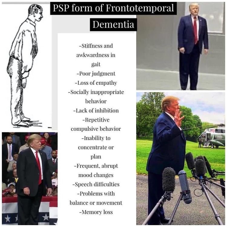@RpsAgainstTrump Frontotemporal dementia, the forward posture causes him to need to stand on pads to appear upright. Lack of inhibition (blurting out things in court), inability to concentrate, stiff, awkward gait, incontinence.