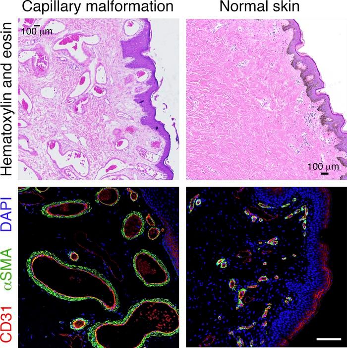 #Review: Capillary malformations: buff.ly/4aF1t6W @BoscoloLab @uofcincy This review is part of JCI's latest #ReviewSeries: buff.ly/49FhecX