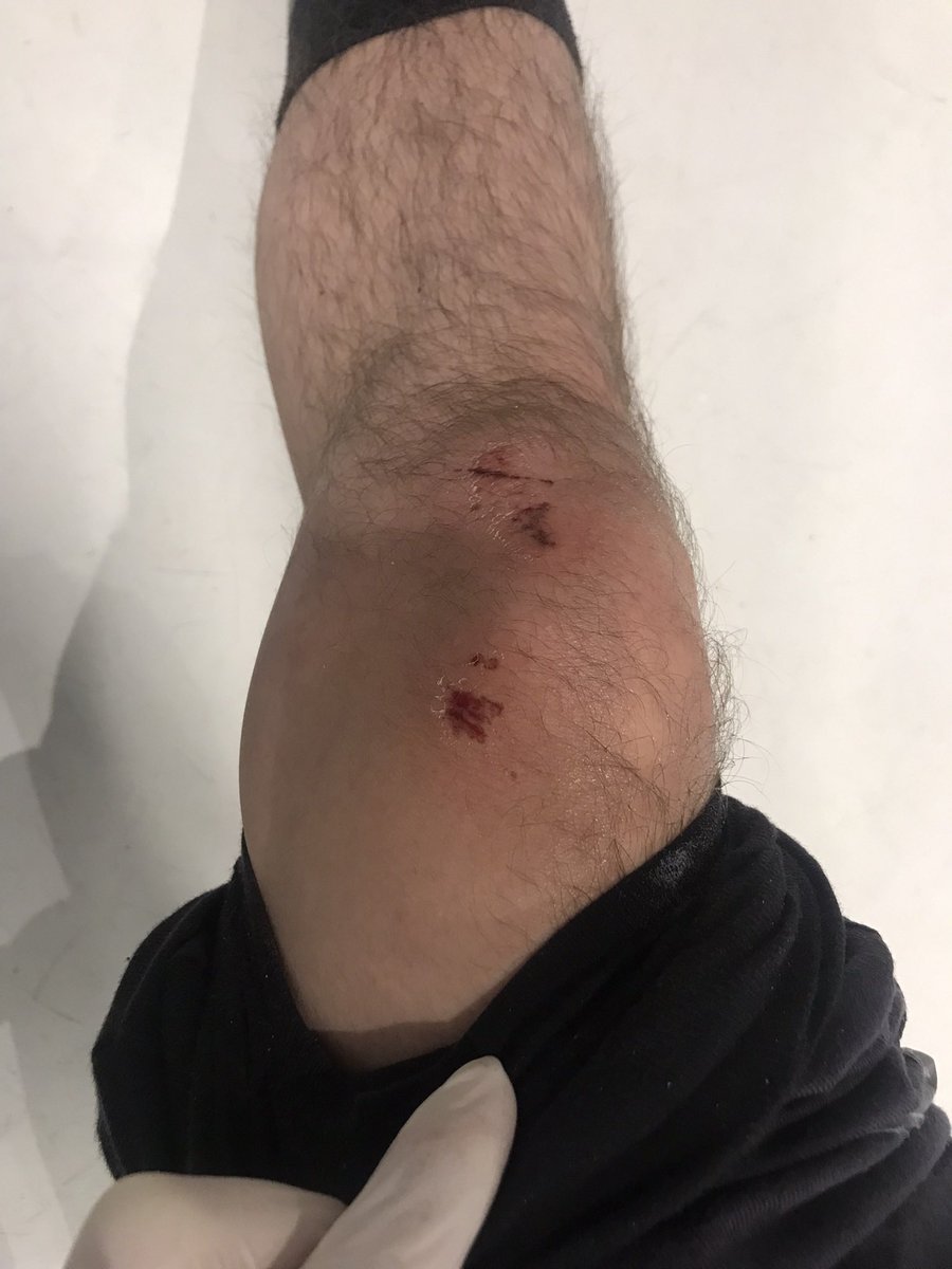 KopekTehlikesi's tweet photo. Bursa'da bir takipçimiz başıboş köpeklerin saldırısına uğradı ve yerde sürüklendi. İnsanlar işe gidip gelirken rutin olarak saldırıya uğruyor. https://t.co/gzS4DbPOZp