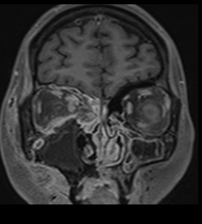 #AJNRcow >> April 18, 2024 >> A 35-year-old, type 2 diabetic woman presents with subacute onset swelling within right nasofacial groove, pain, and fever. View the case: ow.ly/9Oum50RjpyK