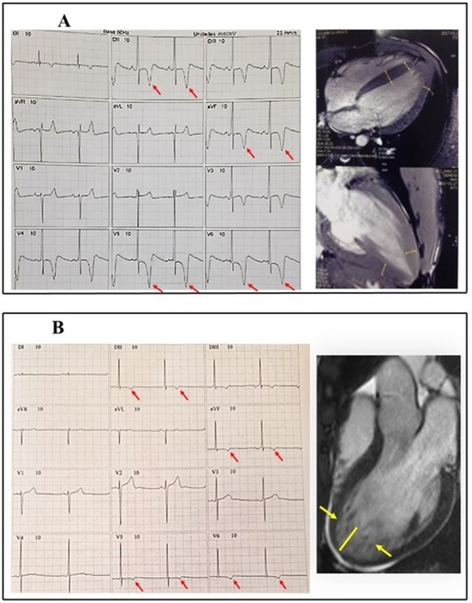 📣 Imaging associations enhance the understanding of ECG abnormalities in male Brazilian football players ⚽️ 🇧🇷 Findings from the B-Pro Foot ECG study 📄 ❤️ READ ➡️ bit.ly/3W3Nvr1