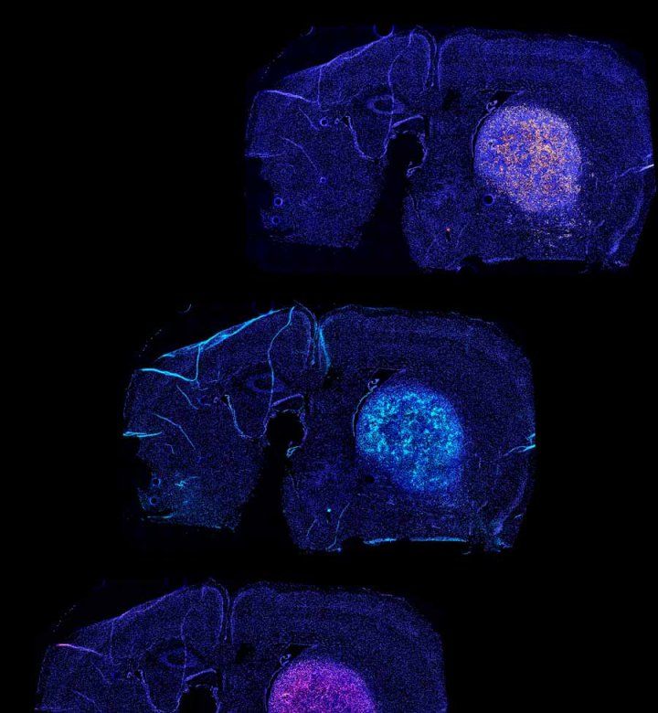 “This project is a prime example of bench-to-bed translation within UCSF, representing the strengths in basic and clinical science, ' said Hideho Okada, @OkadaLabUCSF1 @NeurosurgUCSF “We have a truly home-grown project here.' ow.ly/RHMi50Rjv6j