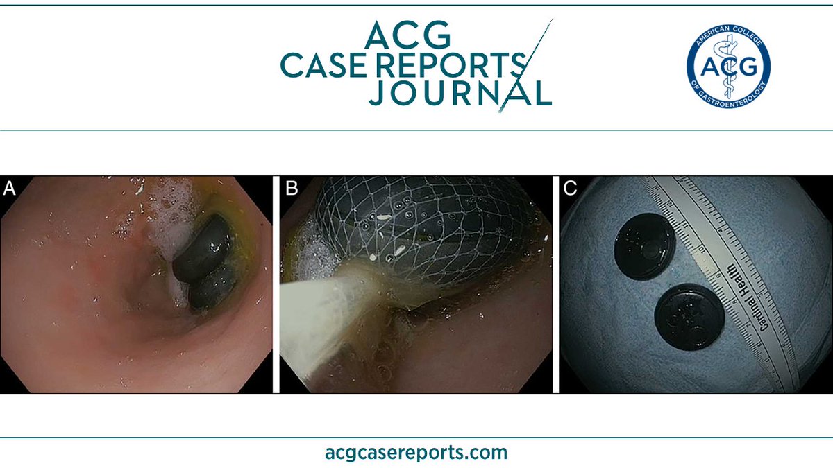 🔎 ACG Case Reports Journal 🔍 See Something, Say Something: Global Positioning System Tracker Foreign Body Ingestion as a Unique Presentation of Human Trafficking Mirza, et al. 👉 bit.ly/441Zl6G @JJFordeMD @KhushbooSGala @VibhuC_MD #GIfellows