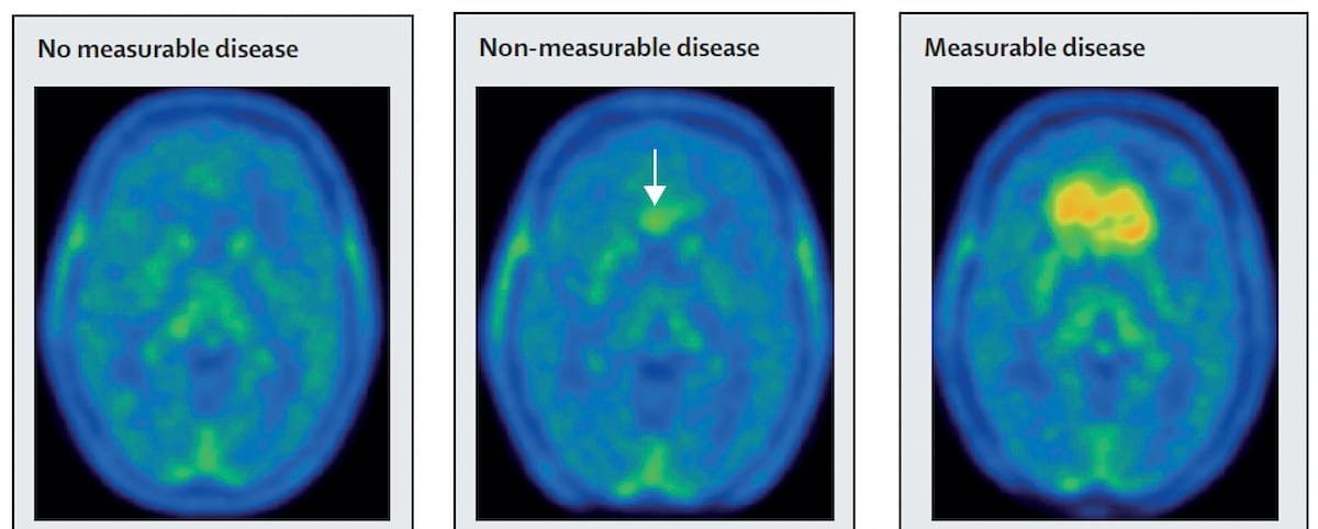 Emerging PET Agent Gets FDA Fast Track Designation for Glioma Imaging diagnosticimaging.com/view/emerging-…
@ACRRFS @ACRYPS @RadiologyACR @ARRS_Radiology @RSNA @JNeuroradiology @TheASNR @EmoryRadiology @PennRadiology @SNM_MI @DukeRadiology @NYUImaging 
#radiology #neuroradiology #RadRes
