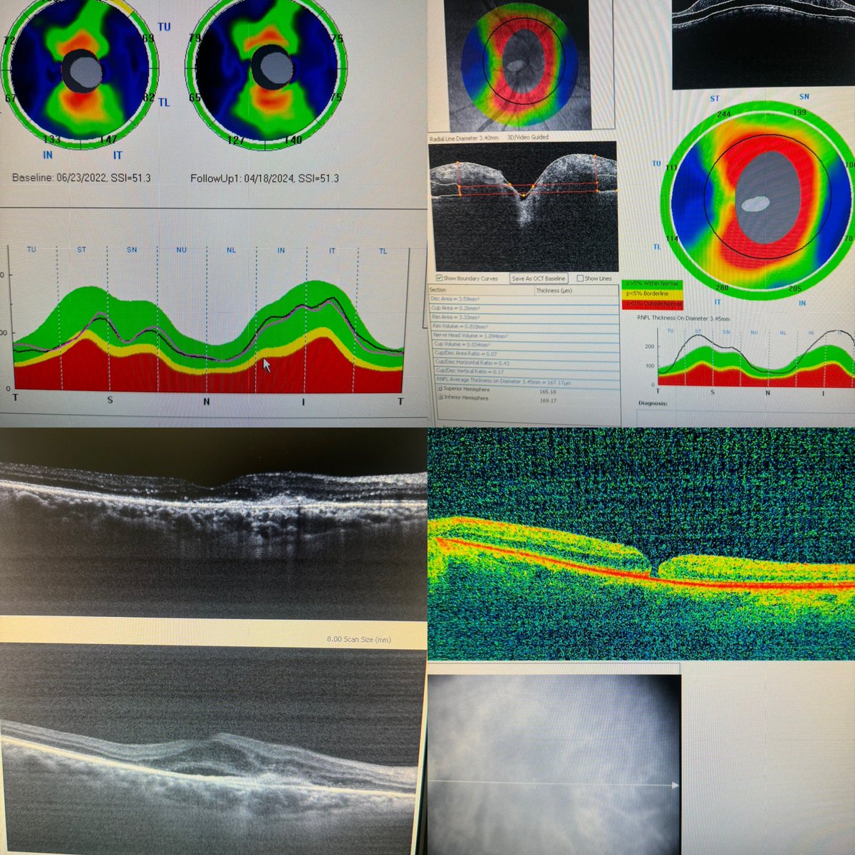 Casos de la semana
1.- sospecha de glaucoma: seguimiento OCT
2.- Edema de papila por esclerosis múltiple 
3.- membrana neovascular activa y depsues de antivegf
4.-agujero macular de espesor total