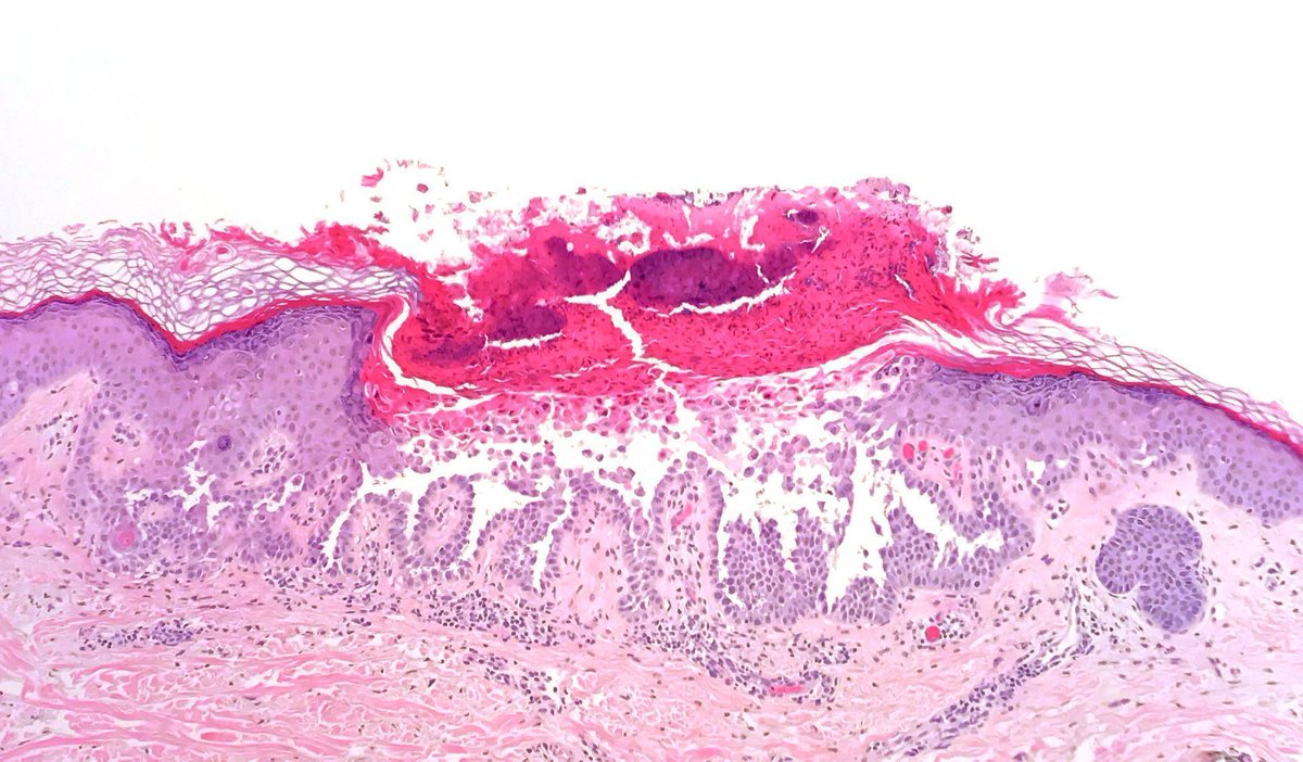 60 yo M. Multiple pruritic papules on trunk. Your diagnosis? 
Answer: youtube.com/watch?v=gnSNni… 
More about this pattern: kikoxp.com/posts/13049
#pathology #pathTwitter #dermpath #dermatology #dermatologia #dermtwitter