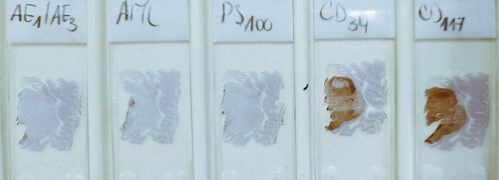 Drmerm's tweet photo. Sometimes we don't need a microscope 😅 
#grossing #PathTwitter #pathology  #medpath #MedTwitter #xpath #pathtweetaward #GIpath #pathology #PathTwitter https://t.co/4C84UNudIw
