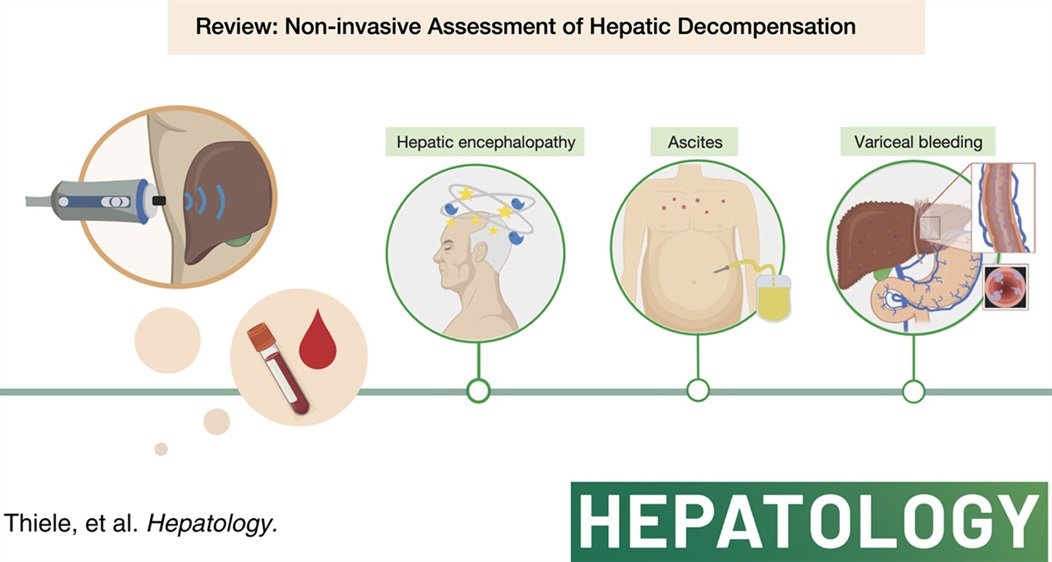 REVIEW Noninvasive assessment of hepatic decompensation @MajaThiele et al. #LiverTwitter tinyurl.com/2ykcdxhk