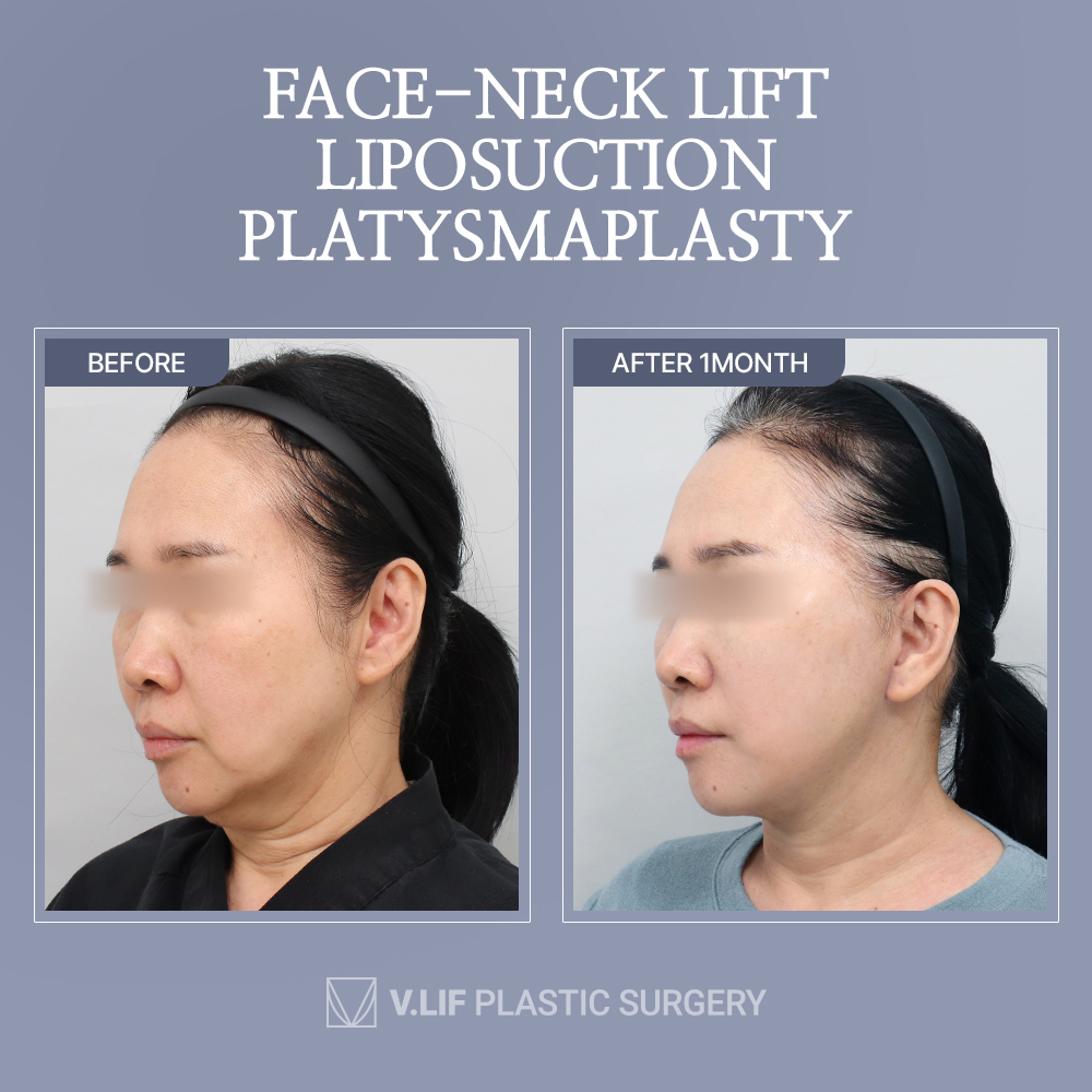 💙#FACELIFT SPECIALIST IN KOREA!💙#vlif

#facelift #necklift #liposuction #facialrejuvenation #browlift #antiwrinkletreatment #antiwrinkle #antiaging #SkinTightening #liftingfacial #plasticsurgery #plasticsurgerykorea #doublechin #plasticsurgerybeforeandafter #vlifplasticsurgery