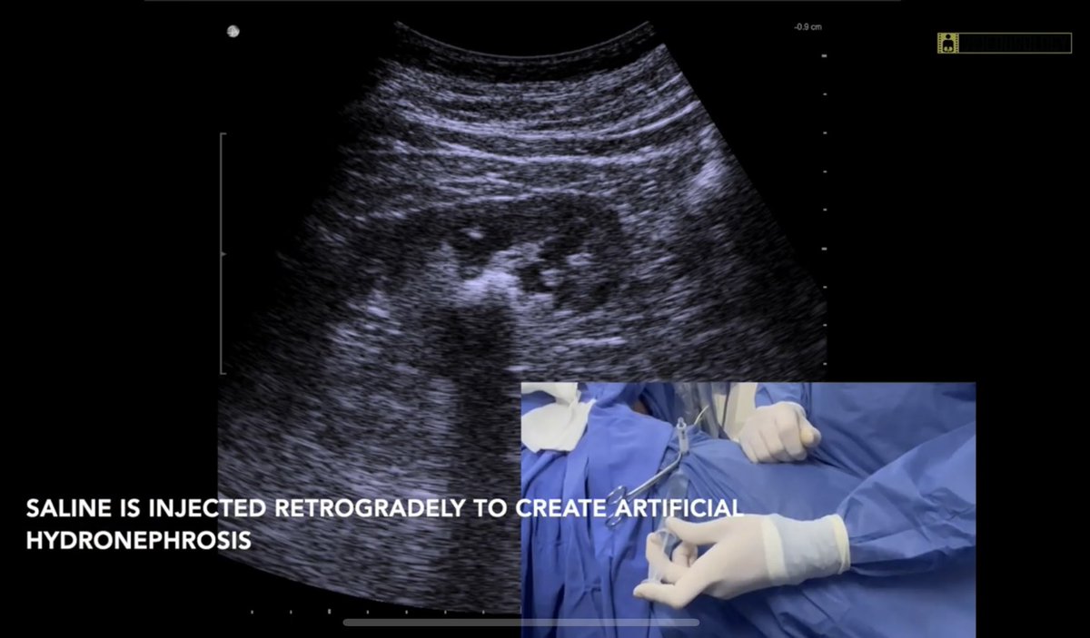 Super Mini-Perc: Totally Ultrasound Guided with a Two-Step tract dilation technique.

Happy to publish our video in #Videourology J Endourology 
@Urologia_UMAET1
 
liebertpub.com/doi/10.1089/vi…

@MyUrologist @MAGarciaPadilla @UroMedrano @urologorios @urolaf