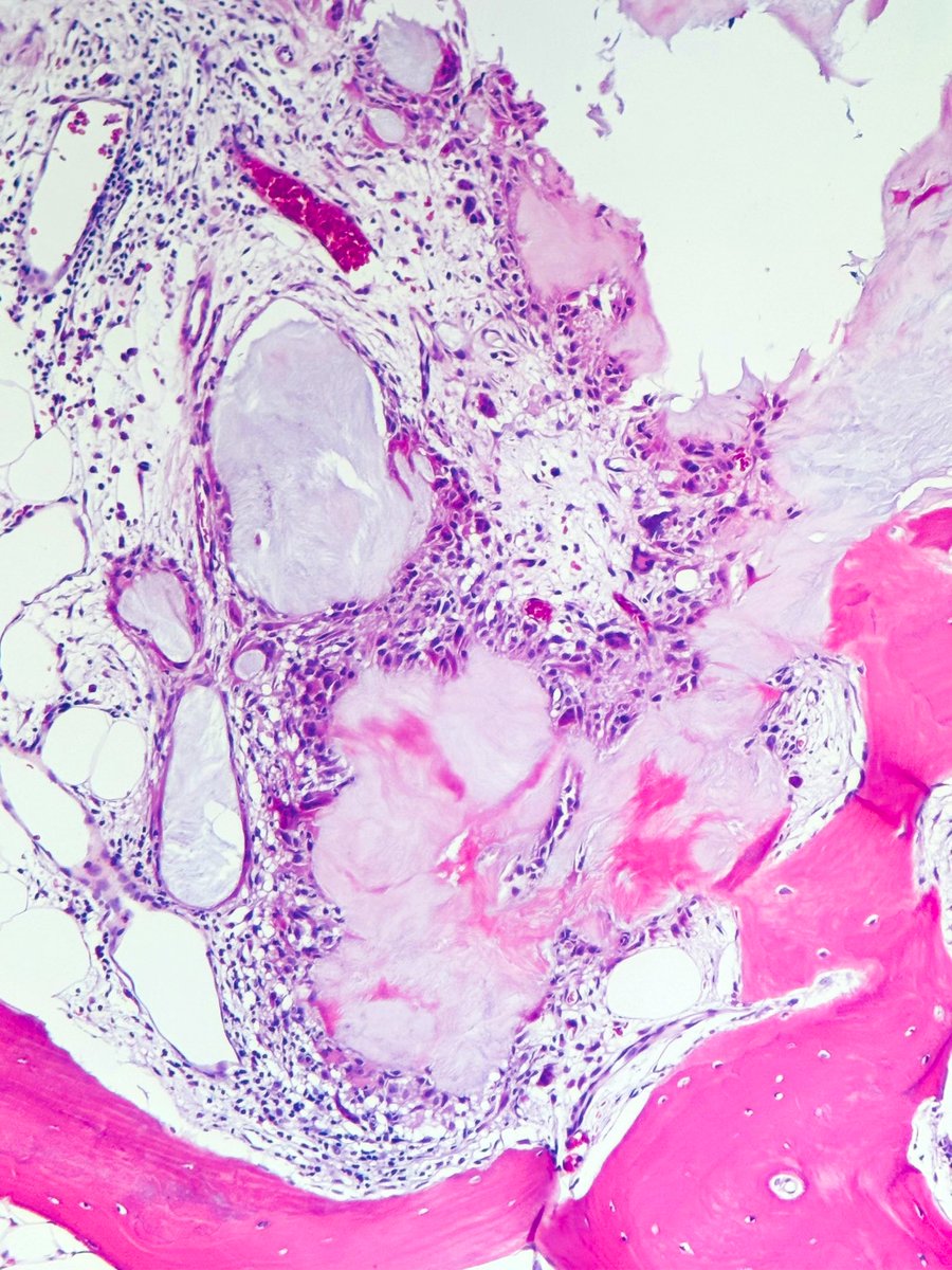 #everydayBST Gouty tophi #BSTPath #pathtwitter #PathX #pathology #PathResident #NIPPathX