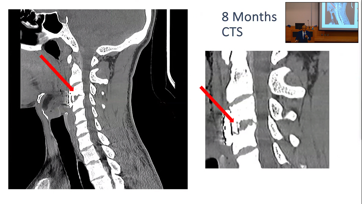 Thanks to @PittNeurosurg's Joseph Maroon, MD, for joining us at #GrandRounds this morning! Great to hear about the lessons he's learned over his career treating cervical neuropraxia and other spinal cord injuries in professional athletes.