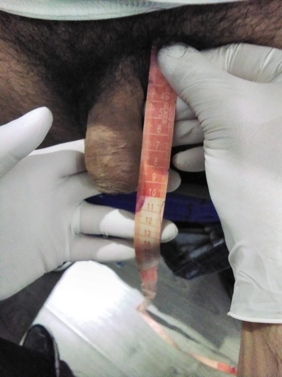 DefinicionC's tweet photo. Aquí tenemos el antes y después del engrosamiento de pene con grasa 
Muy buenos resultados en poco tiempo https://t.co/dp6MisgX4n