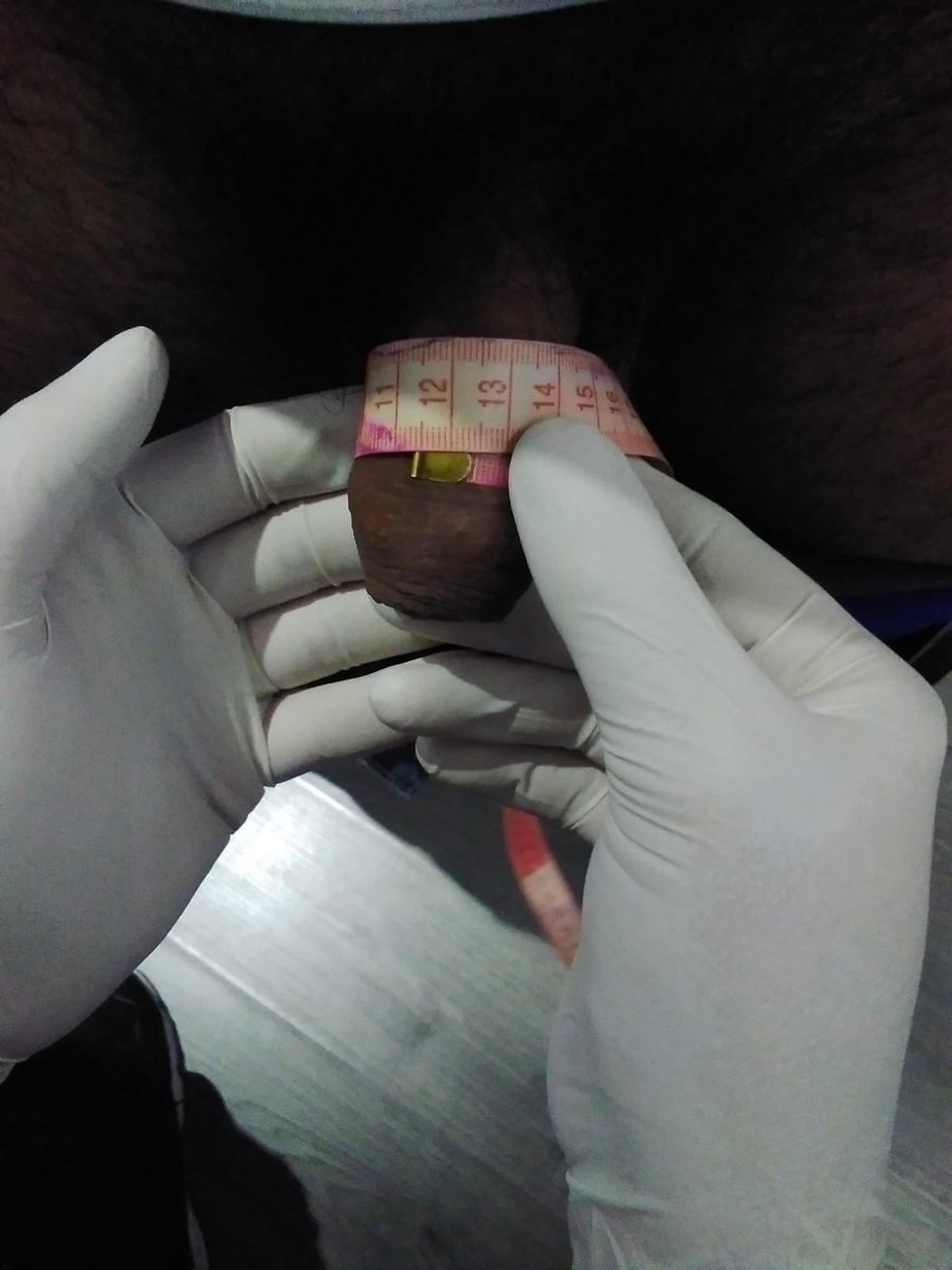DefinicionC's tweet photo. Aquí tenemos el antes y después del engrosamiento de pene con grasa 
Muy buenos resultados en poco tiempo https://t.co/dp6MisgX4n