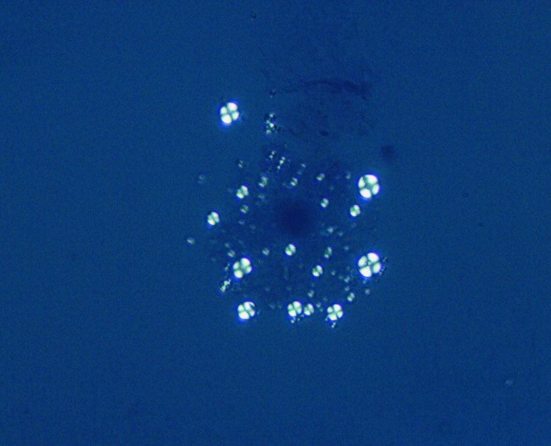 1/n, 70 Y referred to nephrology clinic for evaluation of new onset proteinuria, UPCR:11g/g
📌H/0 HTN at baseline
📌Started on Bevacizumab 90 days ago for new diagnosis of HCC
📌AKI with rise in SCr to 1.5 mg/dl from 1.2 mg/dL and BP ⬆️ 150/90
#UrineSedminet   ⬇️ #LipidDroplets