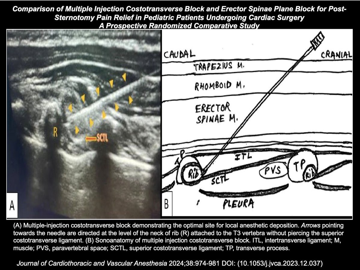 Ultrasound-guided multiple injection costotransverse block was effective and comparable to erector spinae plane block for post-sternotomy pain management in #pediatric #cardiac surgical patients. #RegionalAnesthesia jcvaonline.com/article/S1053-…