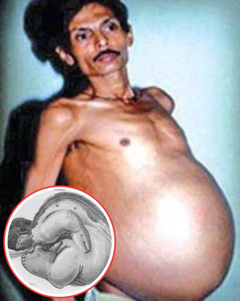 This man was Pregnant with his twin. He had a big belly that made him look like he was 9 months pregnant. Doctors thought it was a tumor, but when they operated on him, they discovered that his parasitic twin had been living inside him for 36 years.