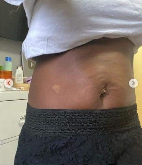 Dear ladies,rub your stomach with aloe mixed with water and onion 🧅,when done rub your stomach with Colgate,works like magic 🪄