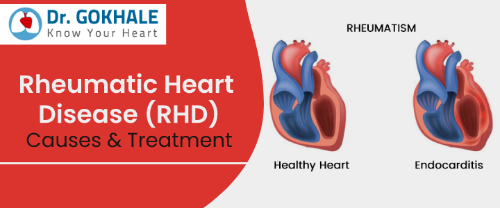 Rheumatic Heart Disease (#RHD) Causes & Treatment

There are more than 25 lakh patients in India who suffer from #RheumaticHeartDisease. And the number of patients affected by this life-threatening heart disease seems to be growing.. 

Know more at: drgokhale.com/blog/rheumatic…