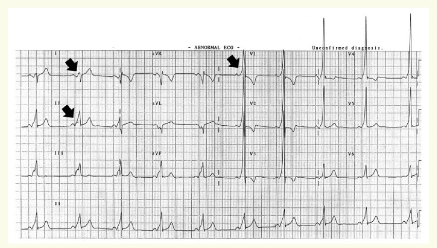 ✅️ Las flechas señalan una onda delta, que se debe a preexcitación por vía accesoria

🚑 Si el paciente asocia palpitaciones o episodios de taquicardia documentada, se denomina síndrome de Wolff-Parkinson-White

💾 10.1093/europace/euw243