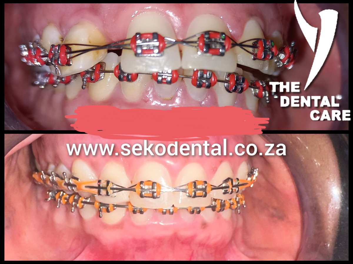 'Unlock your best smile at ANY AGE with orthodontic treatments! Say goodbye to crooked teeth and hello to confidence. Book your consultation today! #AdultBraces Library Gardens ,Polokwane .015 280 0142.0635888906.Moshate Complex,Mahwelereng 0761531476 sekodental.co.za