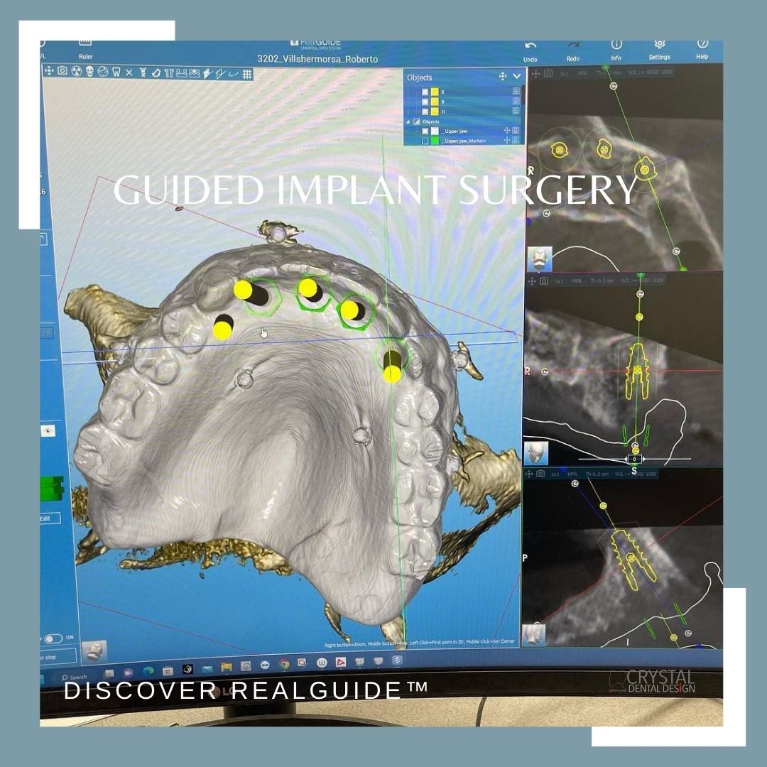 DIGITAL DENTURE GUIDED IMPLANT SURGERY!

crystaldentaldesign.com
crystaldentallab@gmail.com

#dentist #dentallab #dentallaboratory #dentaltechnician #crystaldentaldesign #digitaldentures #guidedsurgery #implantsurgery #dentureguide #dmvdentist