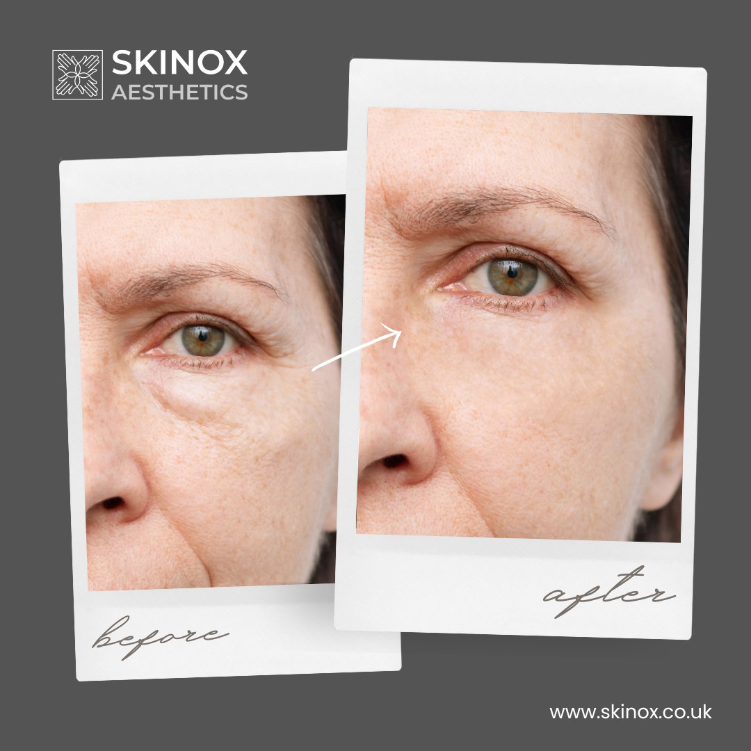 Say goodbye to dark circles and hello to radiant eyes! 👁️ ✨
Check out the stunning results from our tear trough treatment. 
Transform your look today!

Contact us to book in for your free consultation ☎️

 #BanishDarkCircles #SkinoxGlowUp