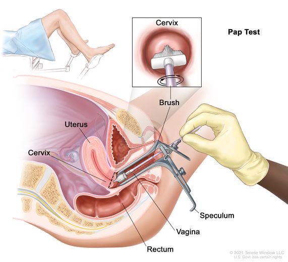 From a friend of mine: “… On another note I had my annual Pap smear and unfortunately came back with very abnormal cells. Grade 3 is the worst and I’m grade 2. So I have to have an outpatient leep procedure and have them cut it out. What was most fascinating is my OBGYN asked me