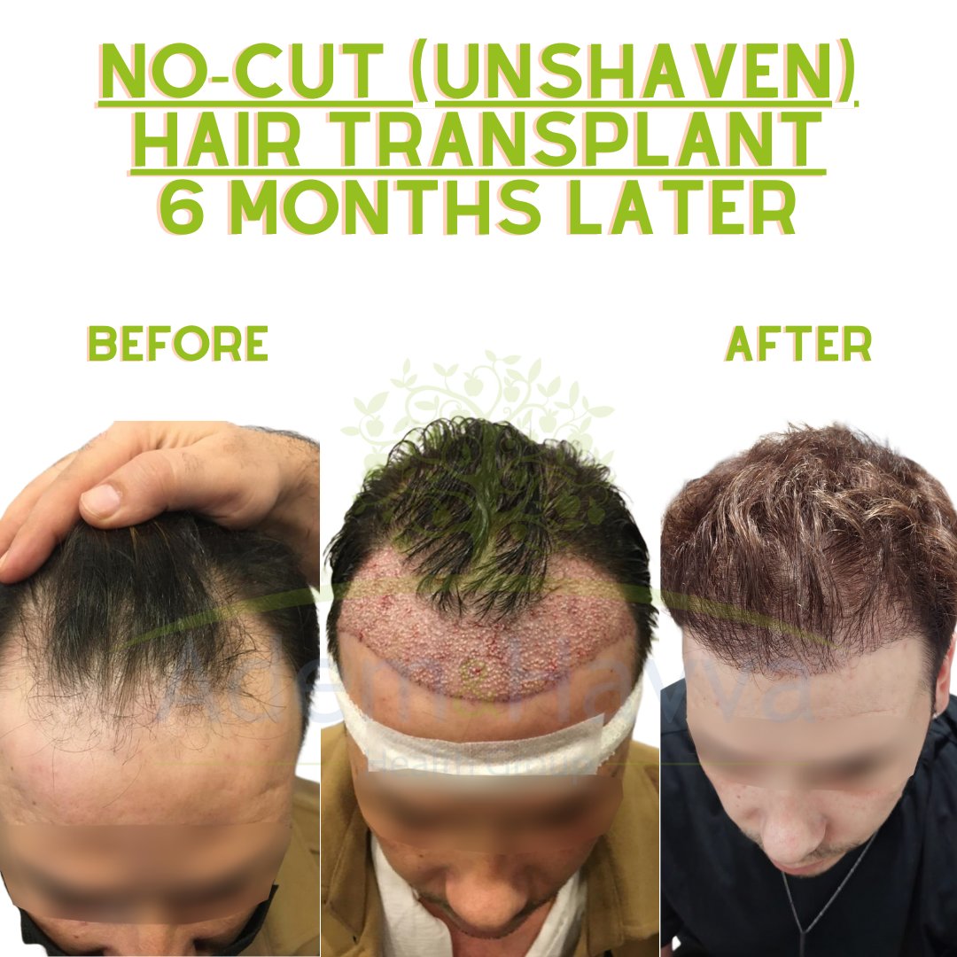 Discover Your Hair Needs with Free Hair Analysis!

🗣️+905496291453 

#Hairtransplant #Fue #DHI #Istanbul #Turkey 
#hairtransplantation 
 #HairCare #HairHealth #HairAnalysis #HealthyHair
 #influencermarketing   #tbt #wcw #fitness #goals 

ademhavva.com.tr/hairtransplant…