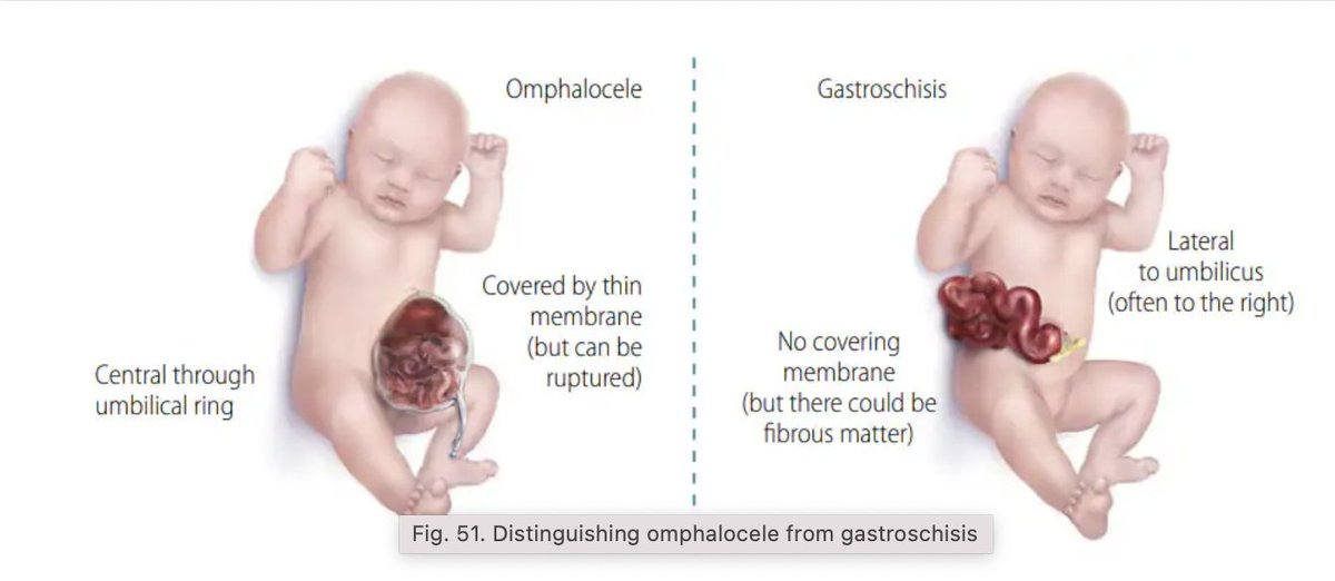 difference between gastrochisis and omphalocele #pediatrics
#gastrochisisvsomphalocele