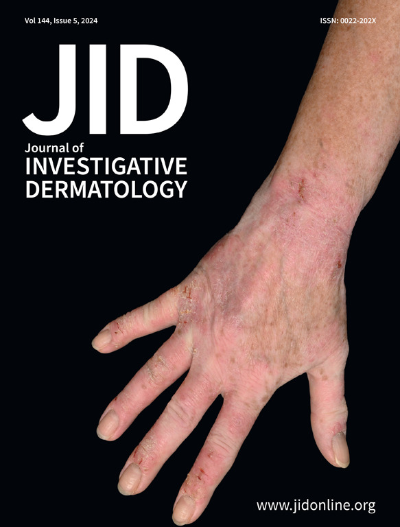 The JID May issue is now online jidonline.org/current 

Spotlight on #AtopicDermatitis: Our May JID cover features a familiar presentation of atopic dermatitis. 
Chronic eczematous lesions on the hand and forearm of an adult female patient with #atopicdermatitis. Erythematous