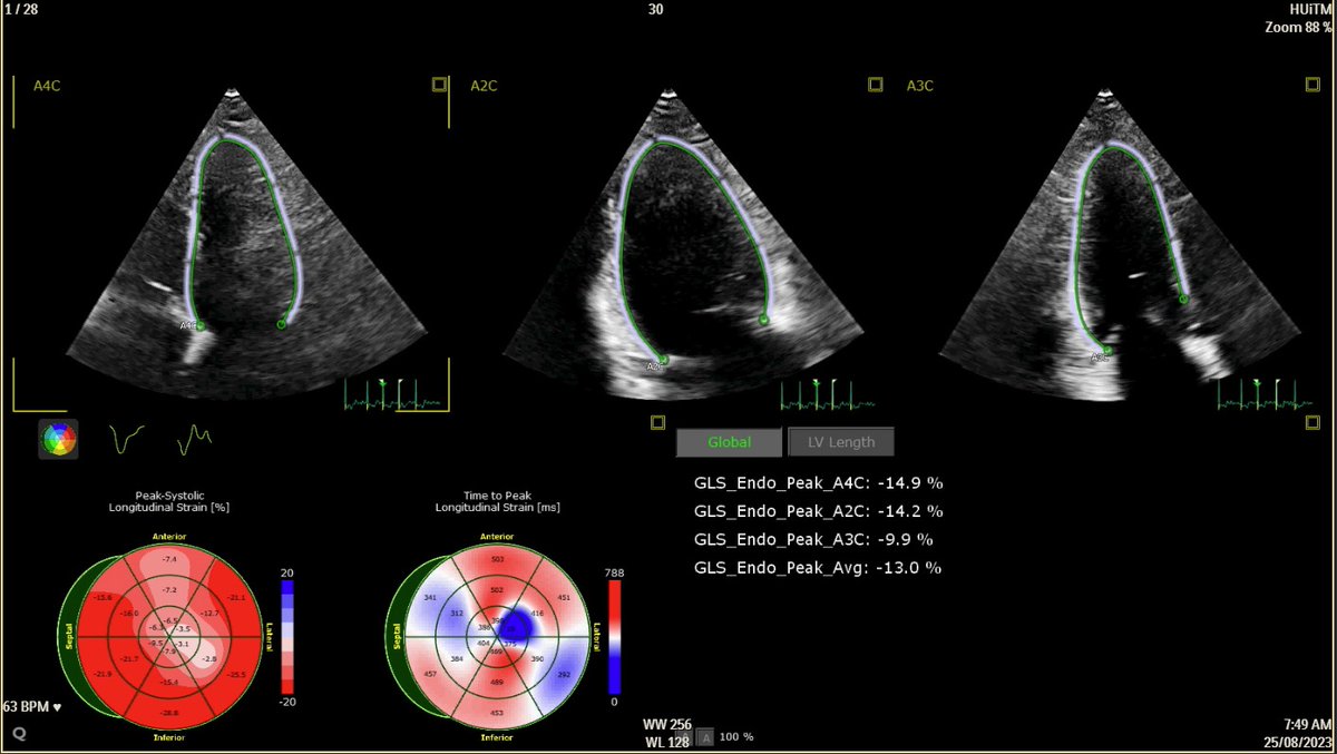 Hoping to pick the brains of #EchoFirst #CardioX #CardioTwitter gurus !!! Can't seem to get the 'Hot Septum' sign despite repeated GLS over 3-4 months.. thoughts?